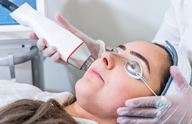 INFINI RF Microneedling Treatment