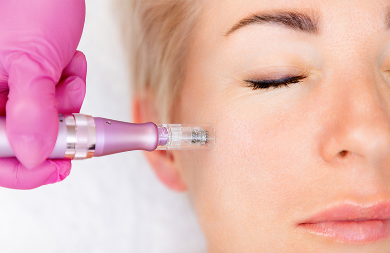 Microneedling Treatment